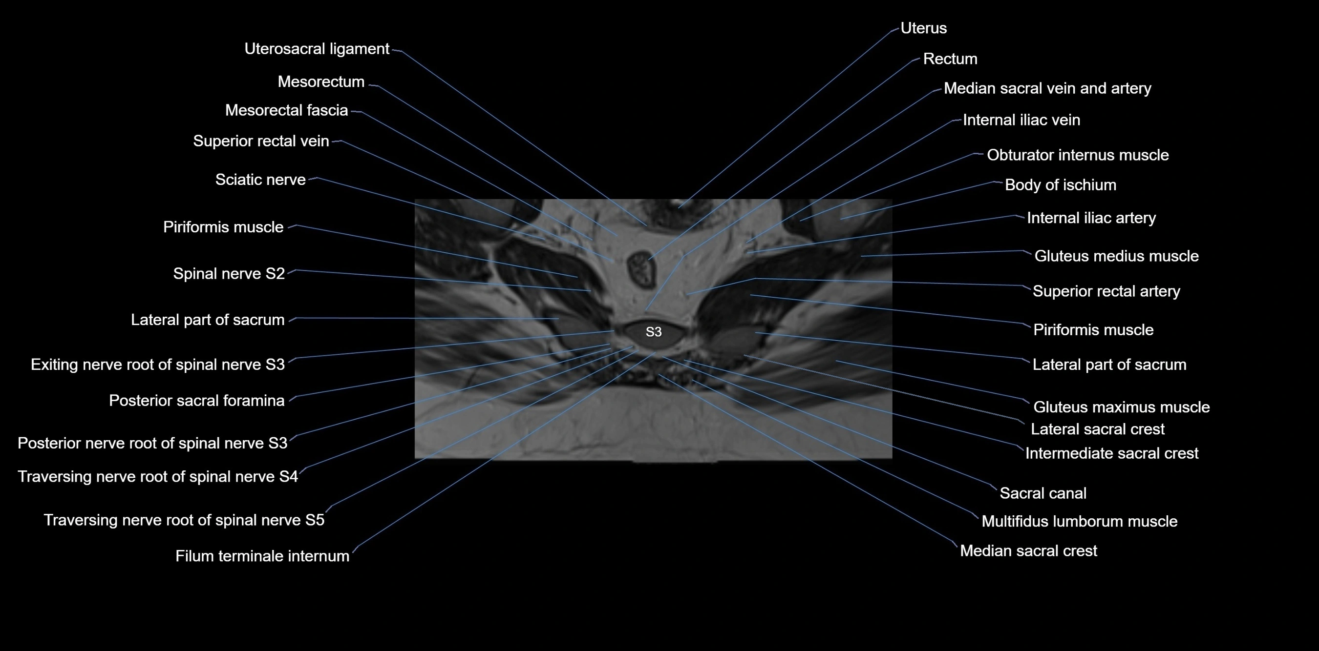 MRI sacrum, coccyx and sacroiliac joint axial cross sectional anatomy 3T  radiology  image-img-00001-00041.webp